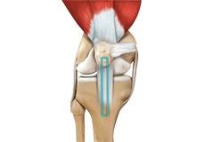 ACL Reconstruction