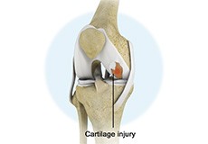 Cartilage Injuries