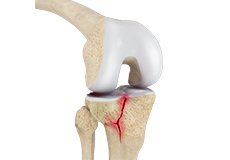 Knee Fracture