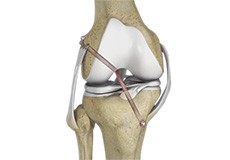 Knee Ligament Reconstruction