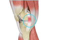 MCL Reconstruction