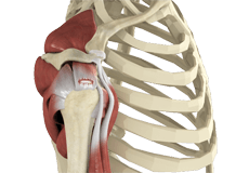 Rotator Cuff Tear